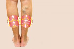 Jak leczyć żylaki nóg?