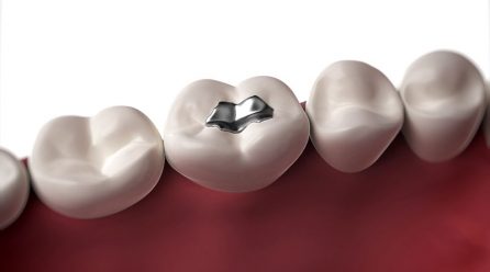 Separatory do amalgamatu – co to takiego?